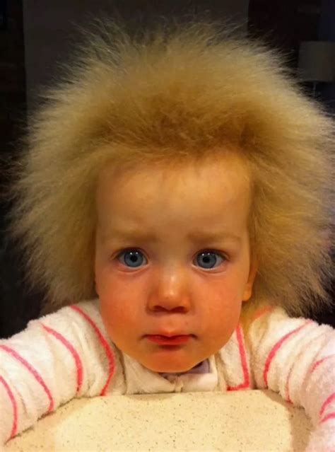 einstein hair syndrome.